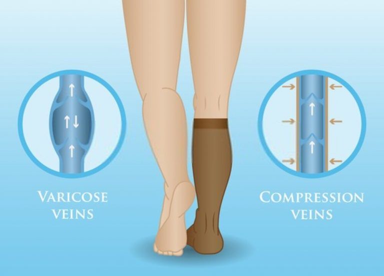 Do Compression Socks Help Plantar Fasciitis? Benefits and Tips Hood MWR