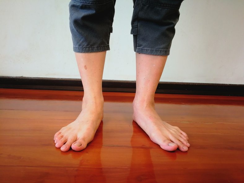 underpronation with flat feet
