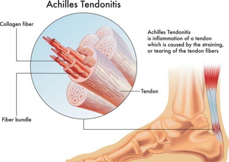 Achilles Tendon Pain When Walking Causes and Exercises Hood MWR