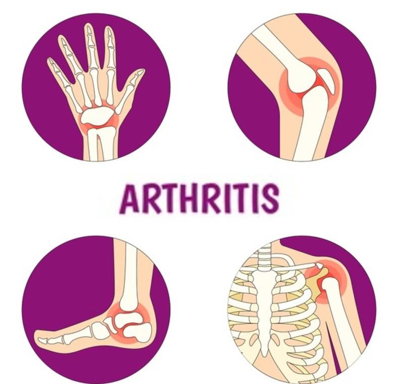 Arthritis