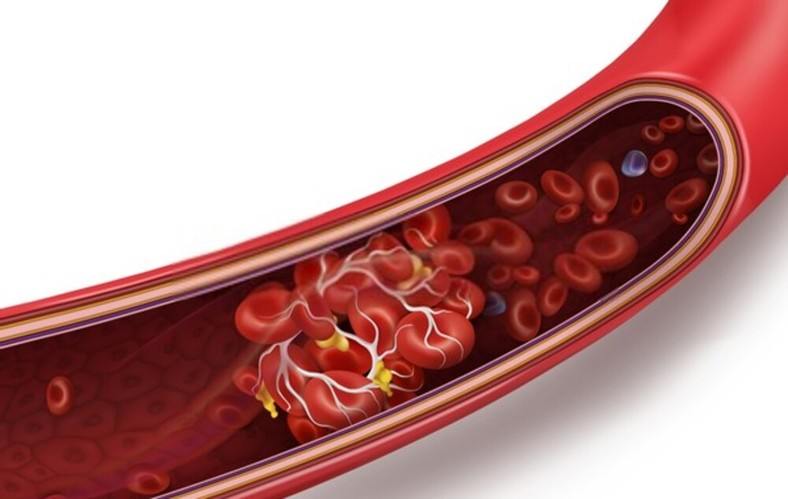 What are Blood Clots?