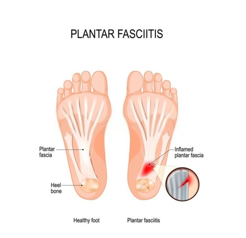 What Causes Plantar Fasciitis?