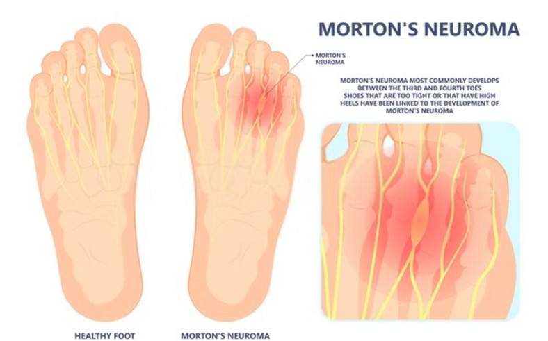 Morton's neuroma