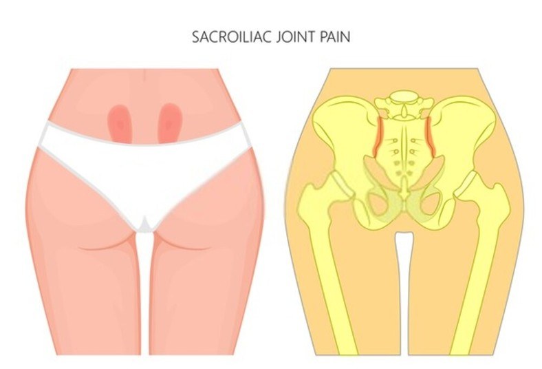 Sacroiliac Joint Dysfunction