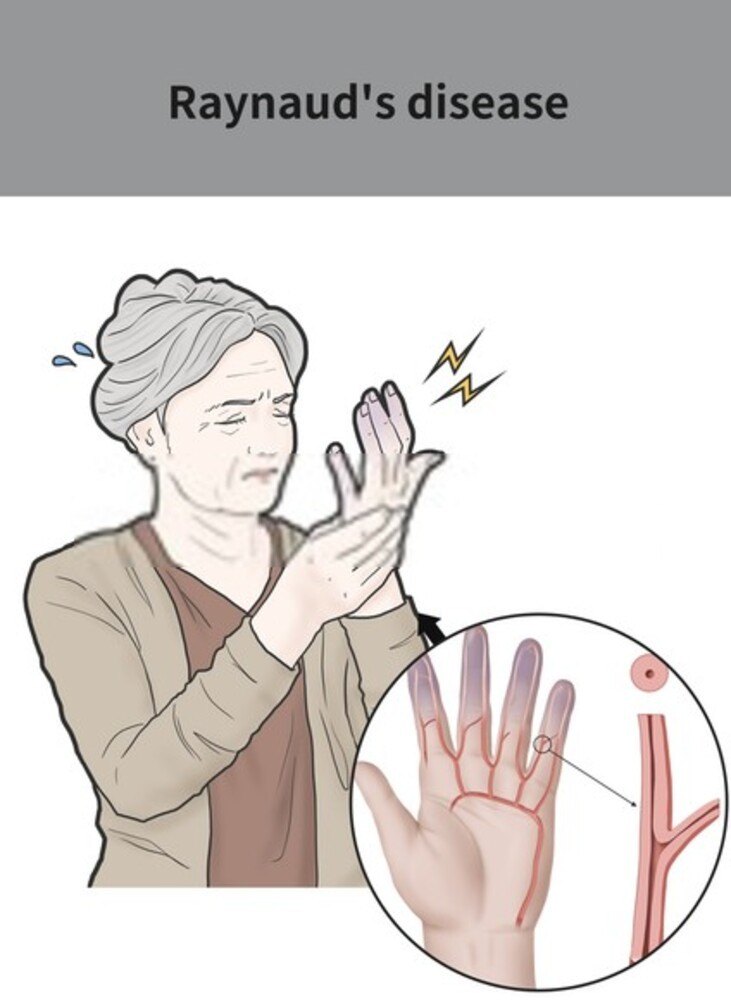 Raynaud's Disease