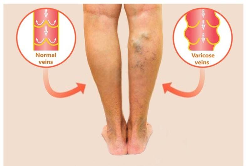 Varicose veins