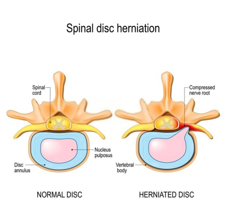 Sharp Lower Back Pain