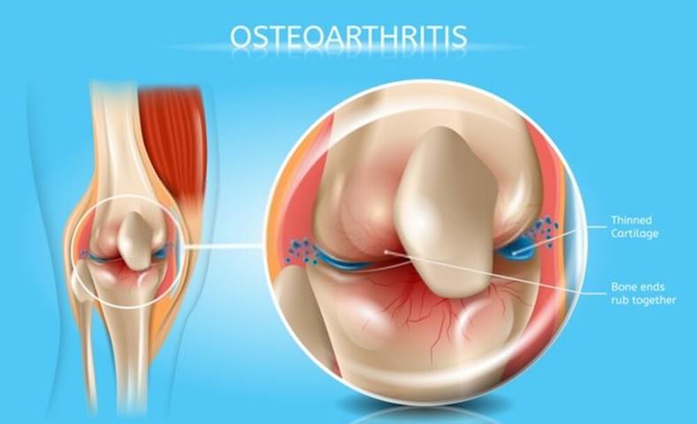  Osteoarthritis 