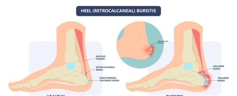 Heel Bursitis