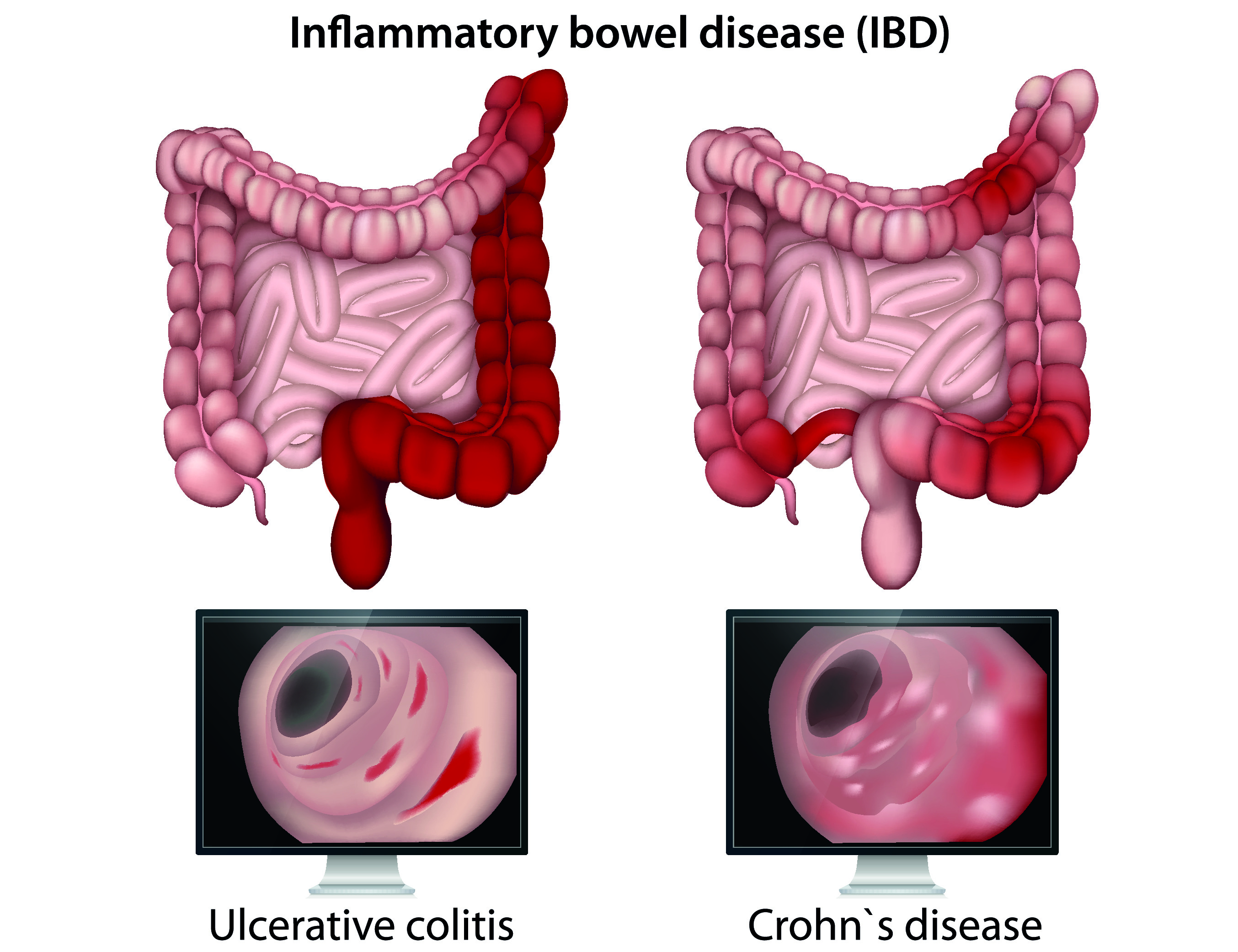 Inflammatory Bowel disease (IBD)
