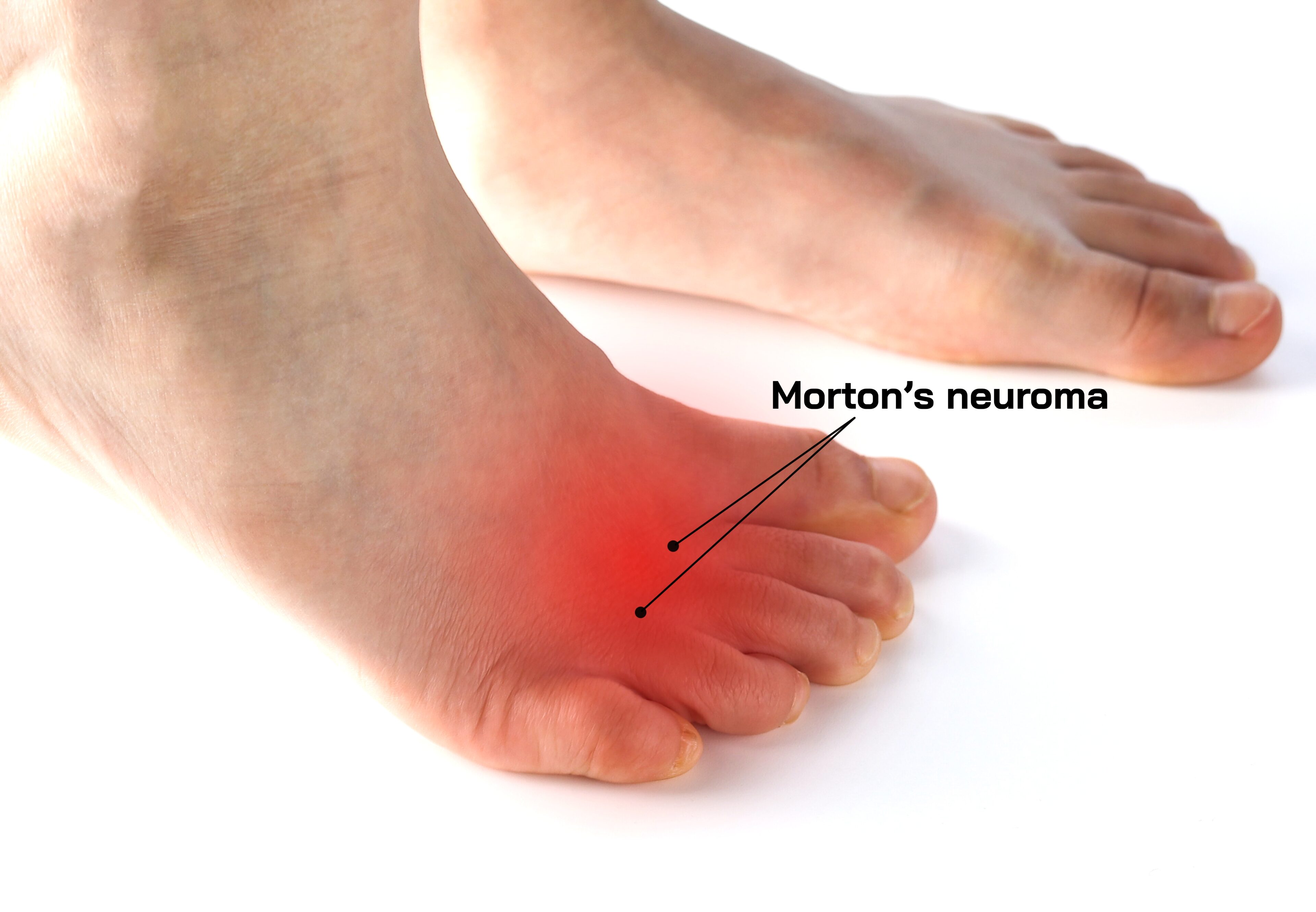 Morton’s Neuroma
