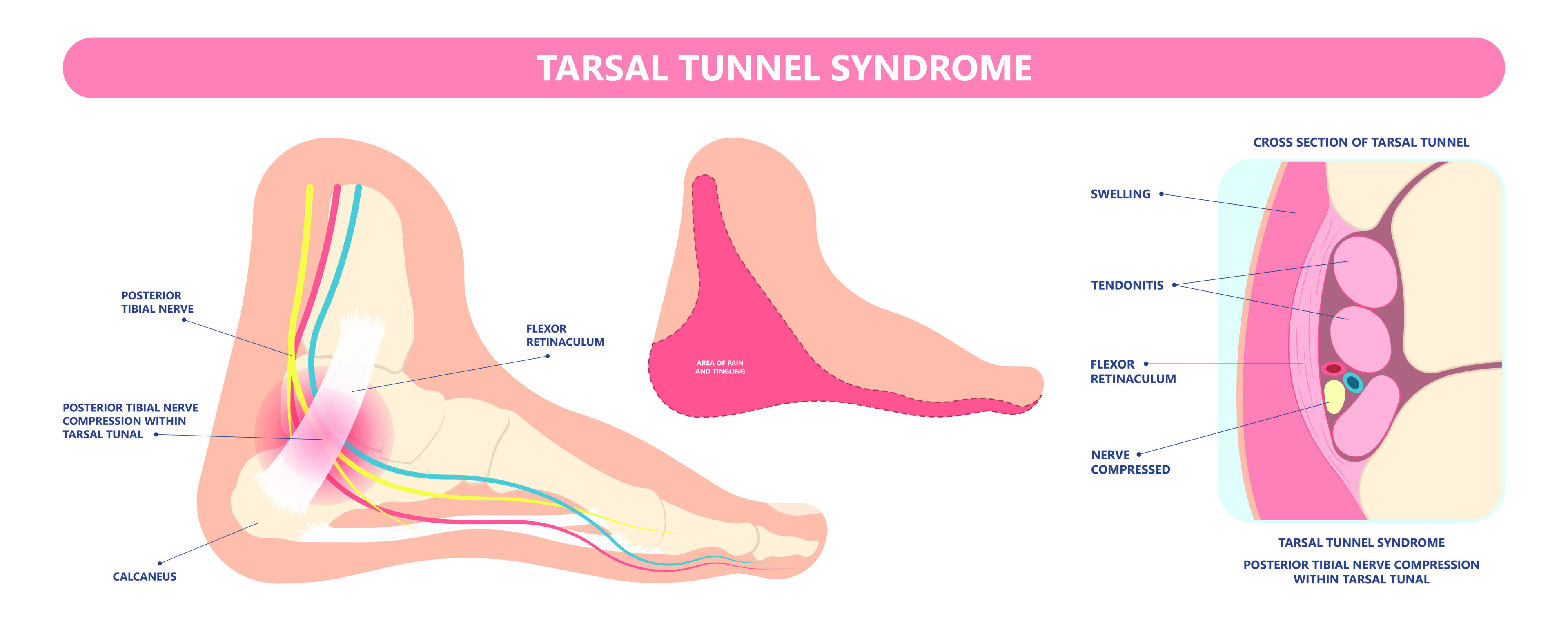 Tarsal Tunnel Syndrome