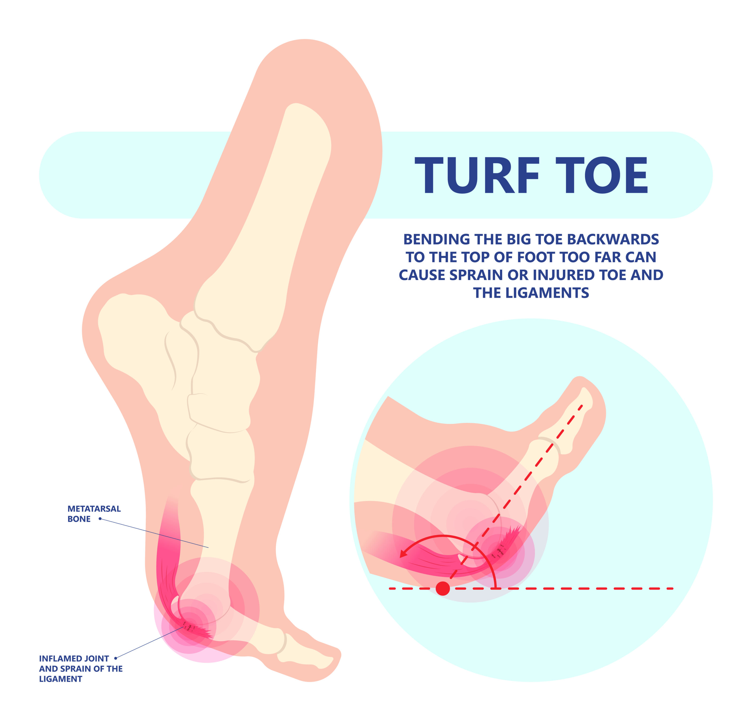 Turf Toe