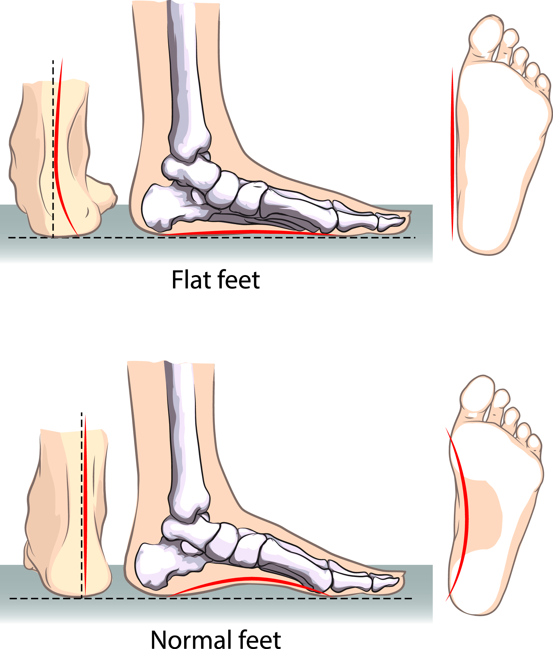Flat Feet  