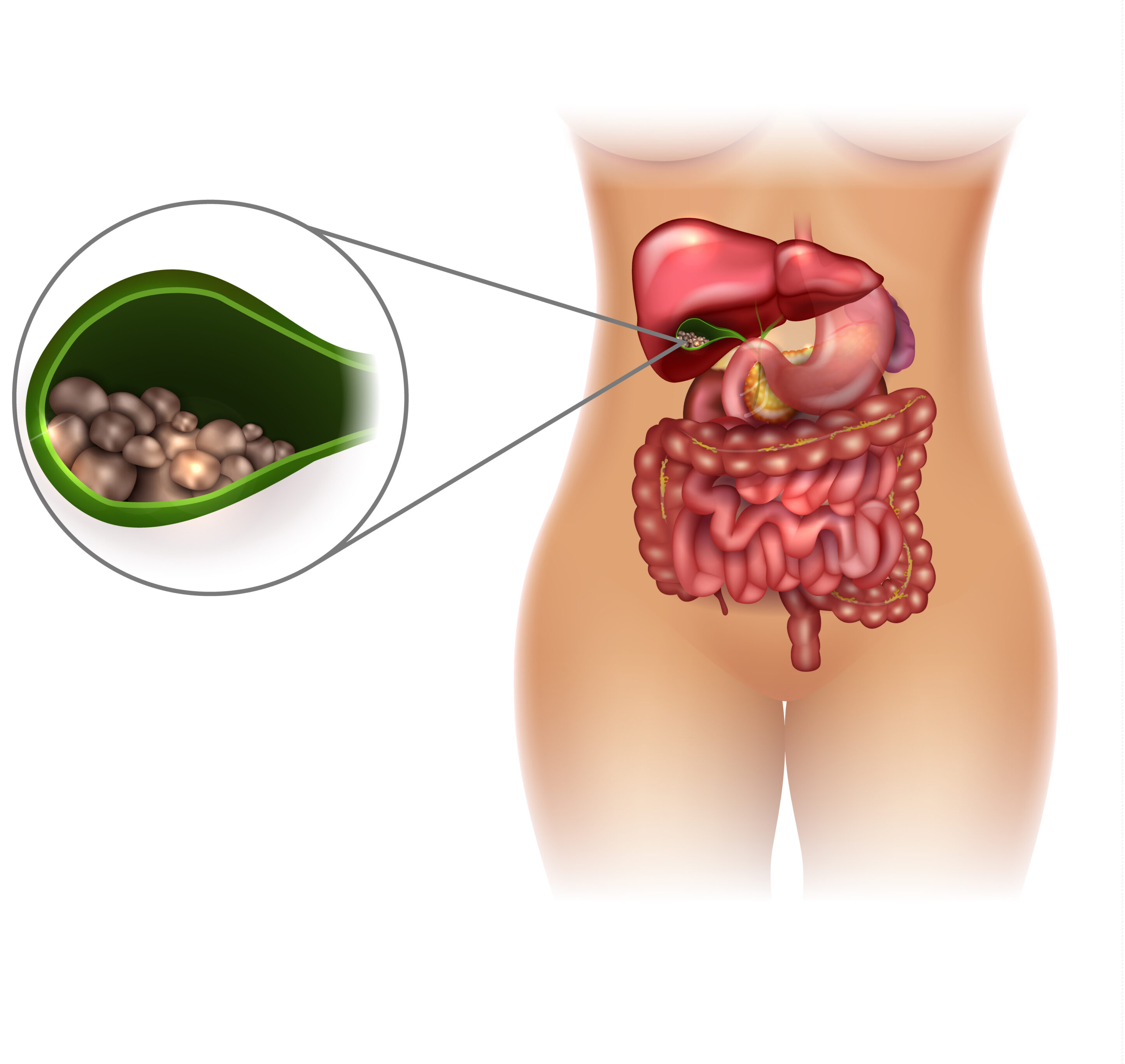 Gallstones Or Cholelithiasis