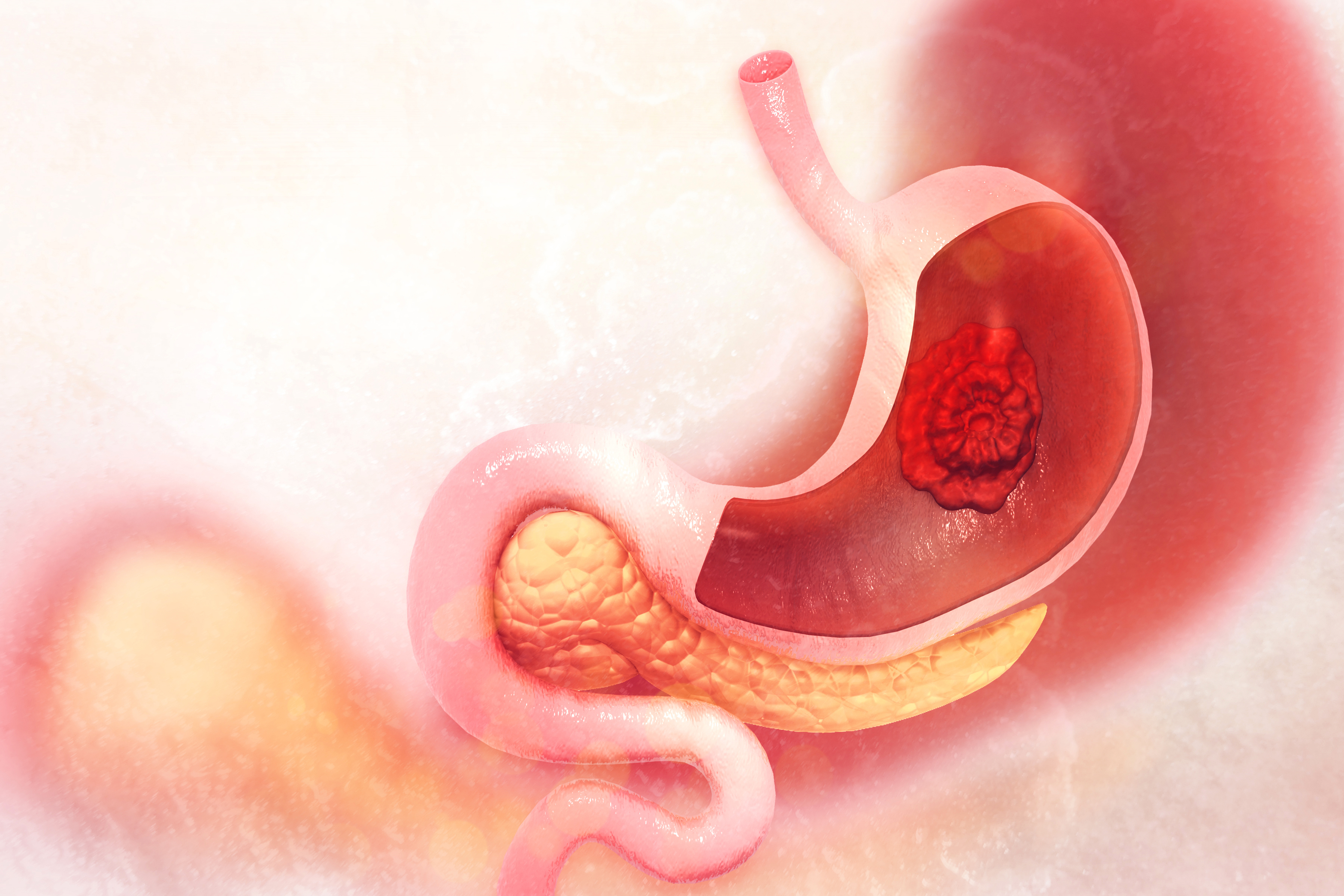 Peptic Ulcer Disease (PUD)