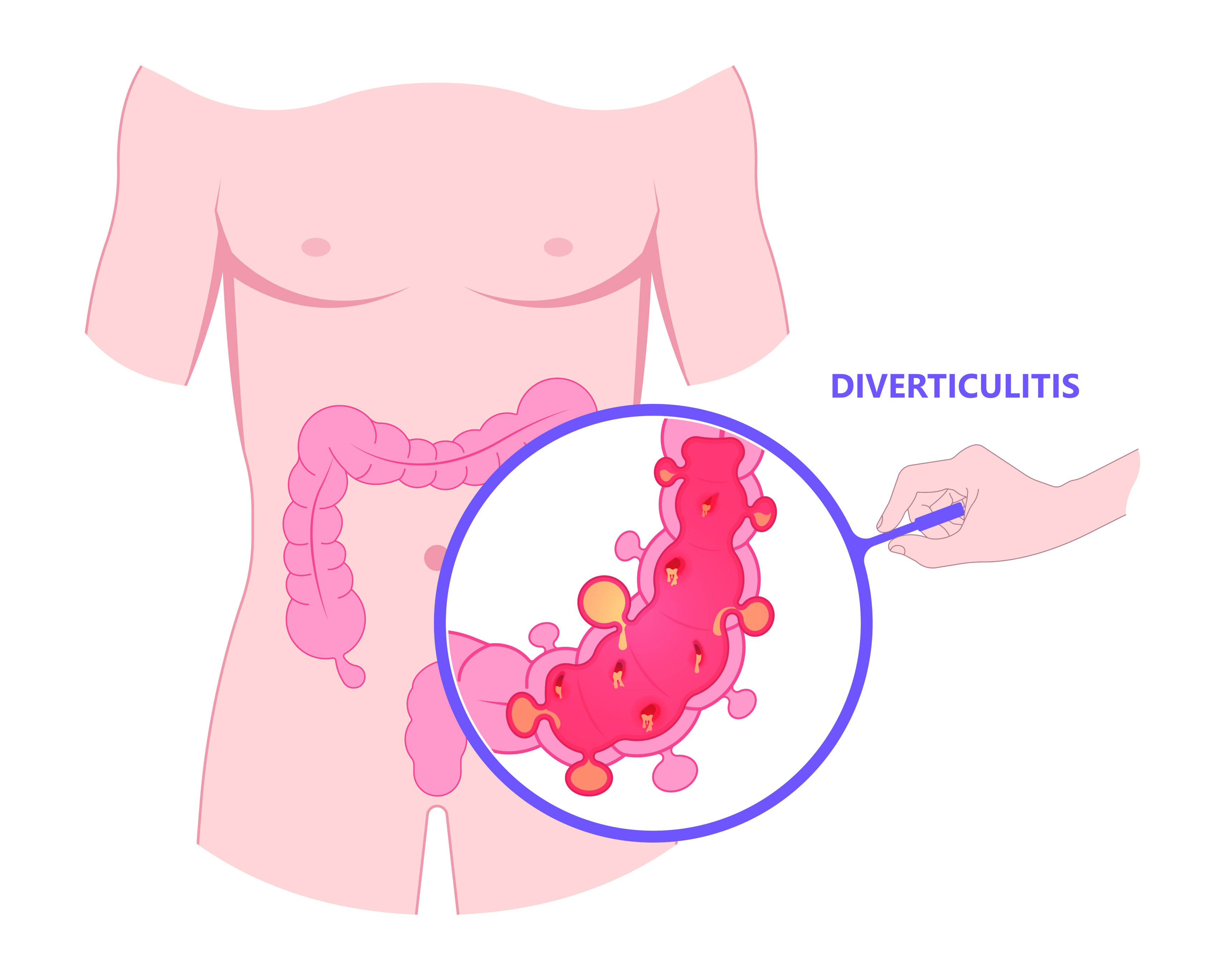 Diverticulitis