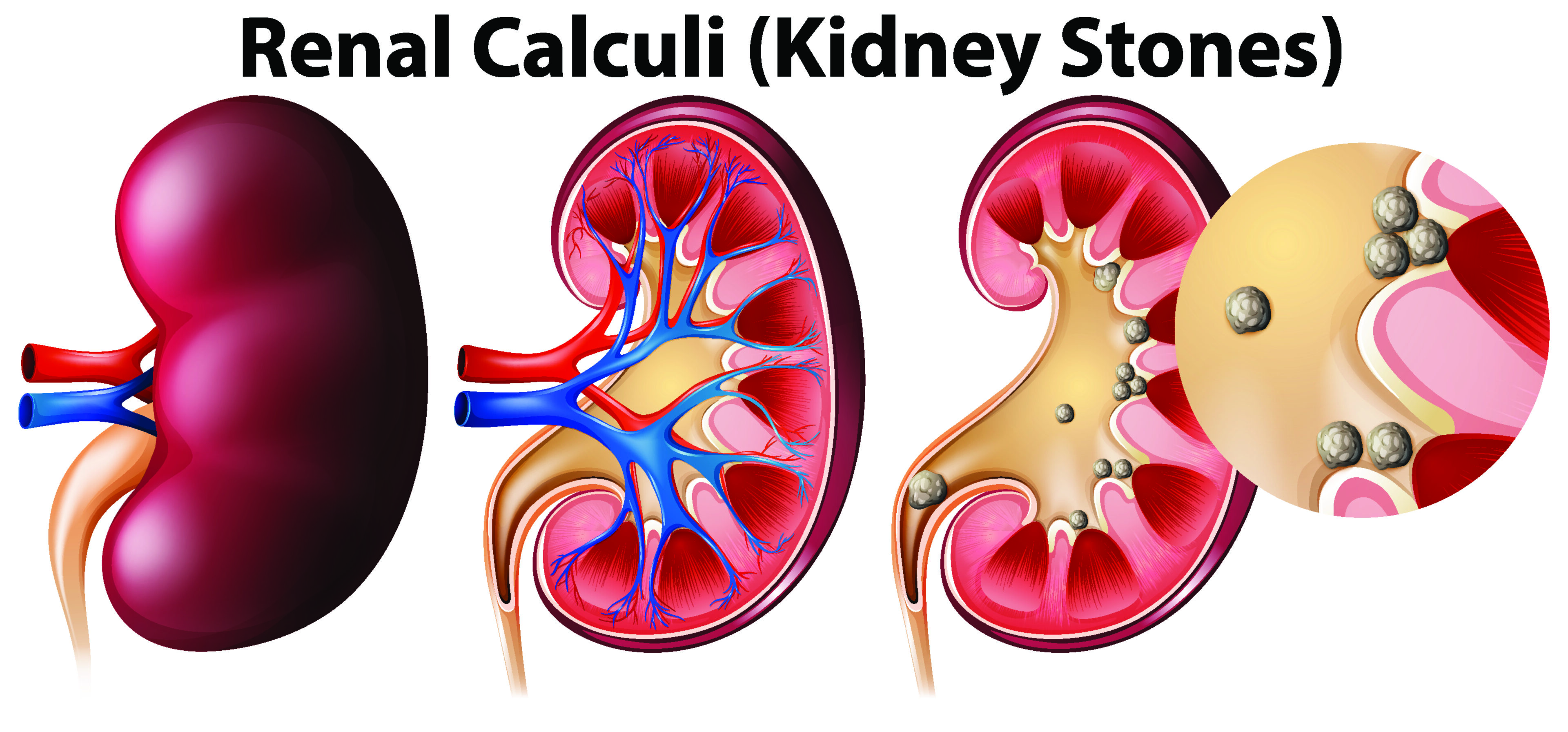 Kidney stones and kidney infections