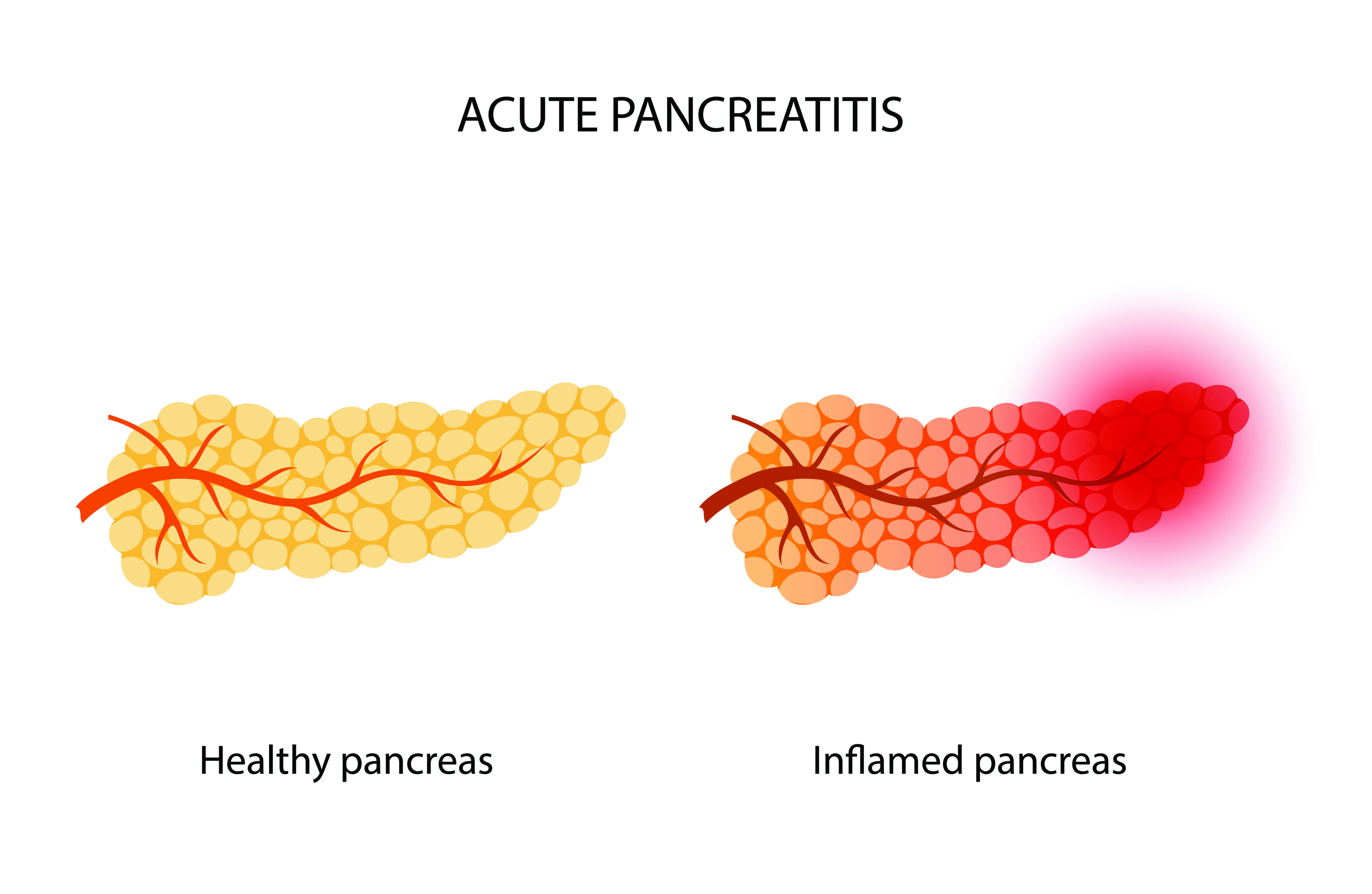 Pancreatitis