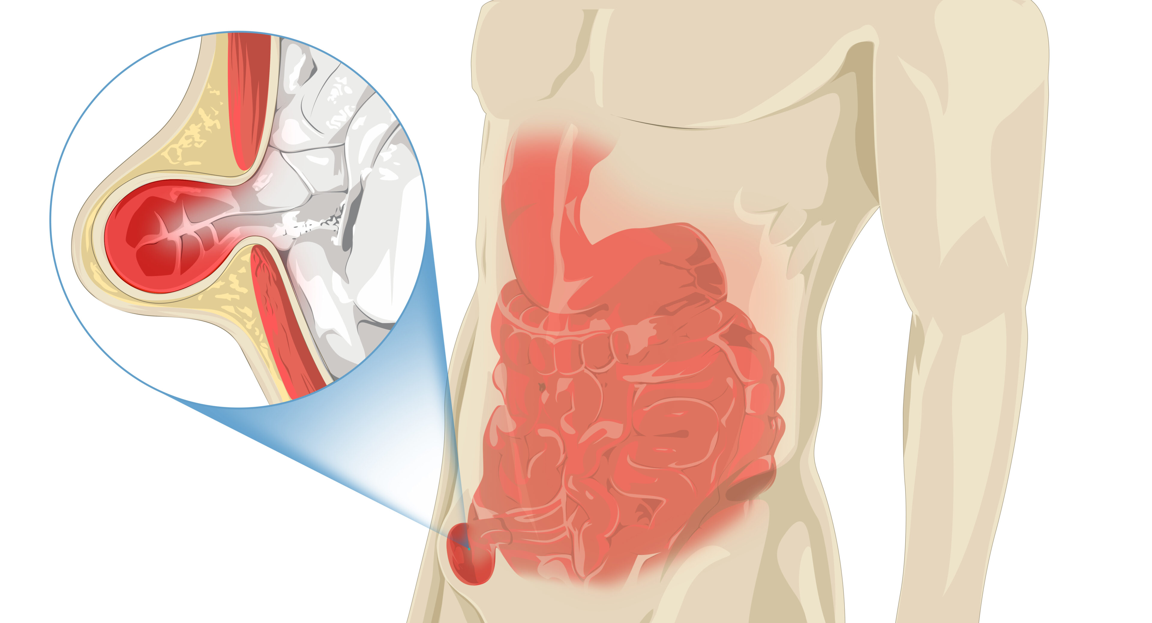 Hernias