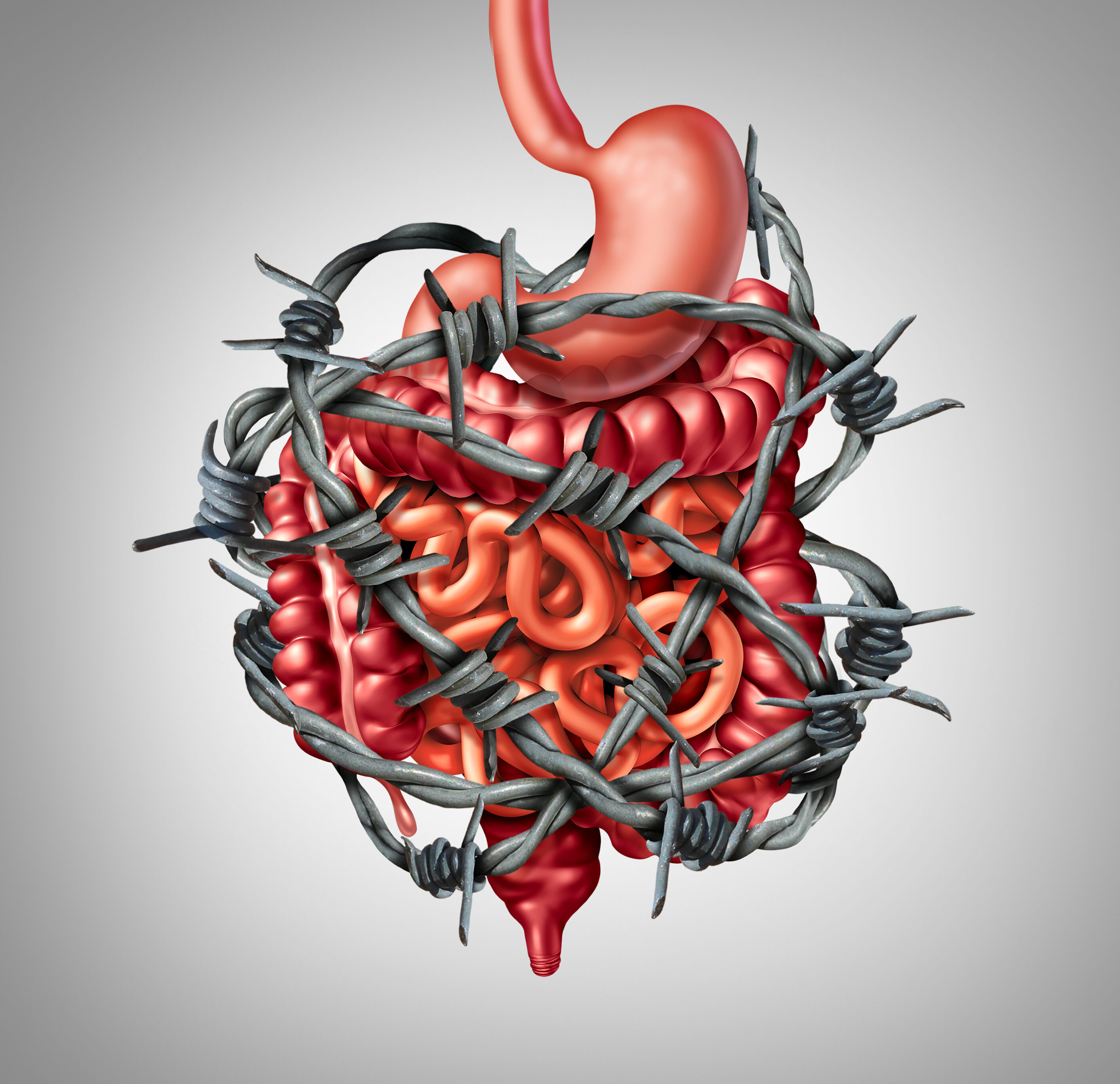 Irritable Bowel Syndrome (IBS)