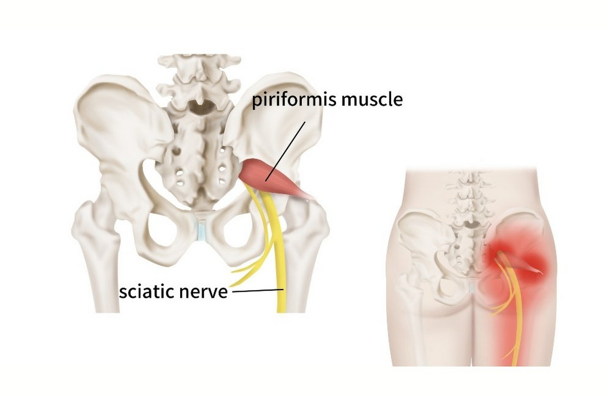 Piriformis Syndrome