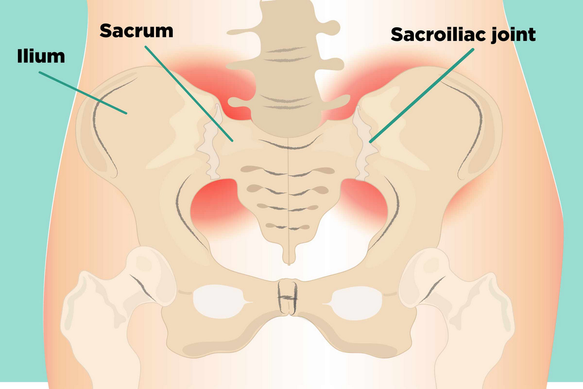 Sacroiliac Joint Dysfunction