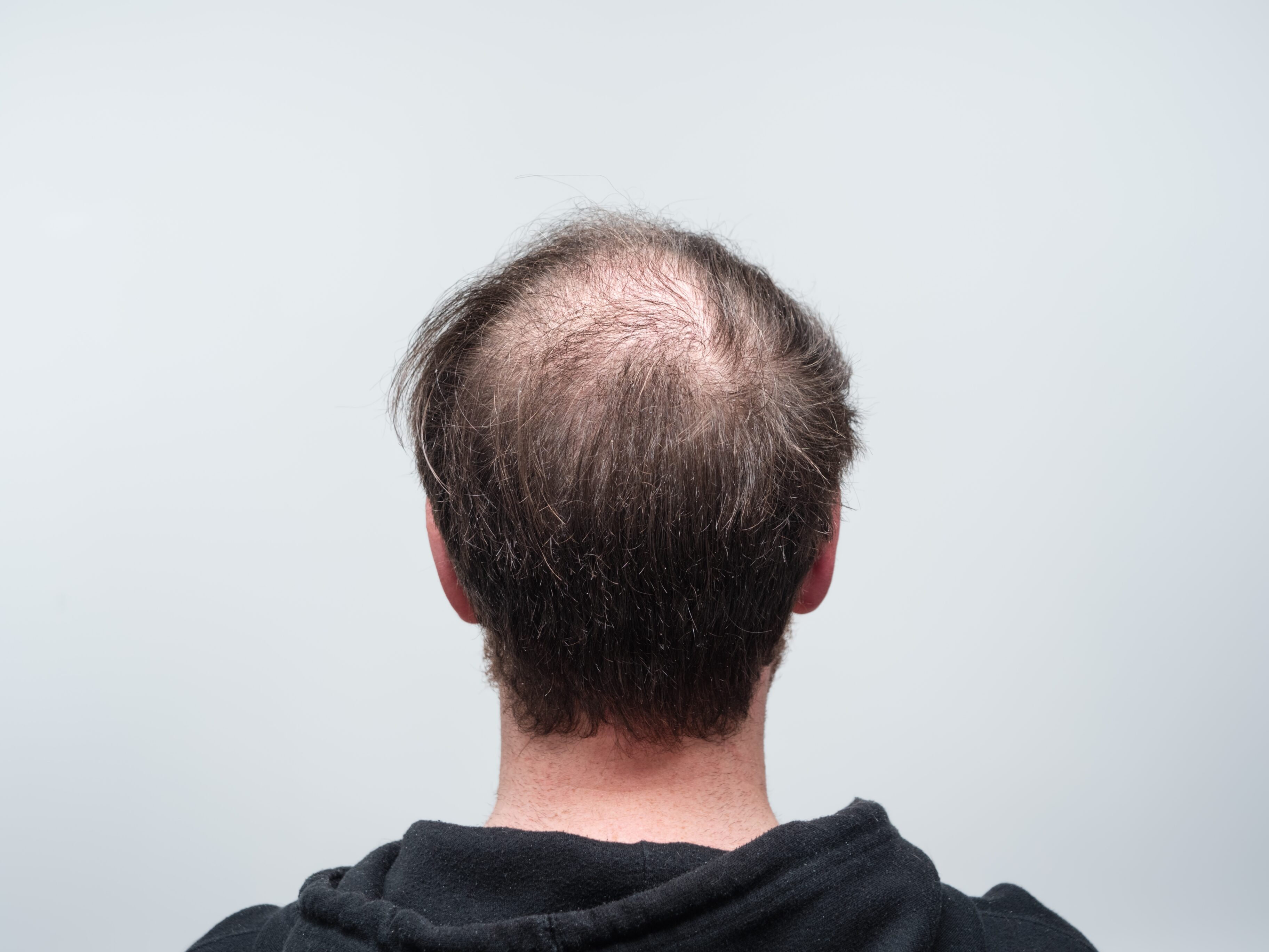 The Clearly Balding