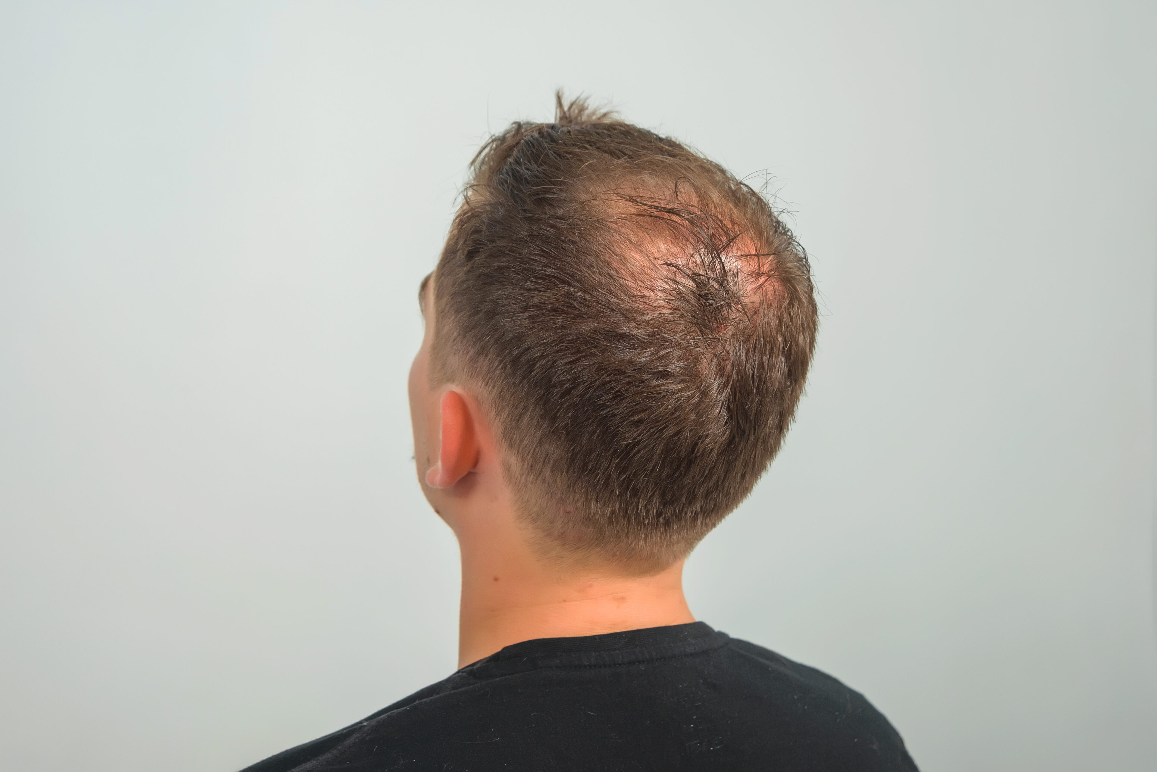 Bald Crown Hair