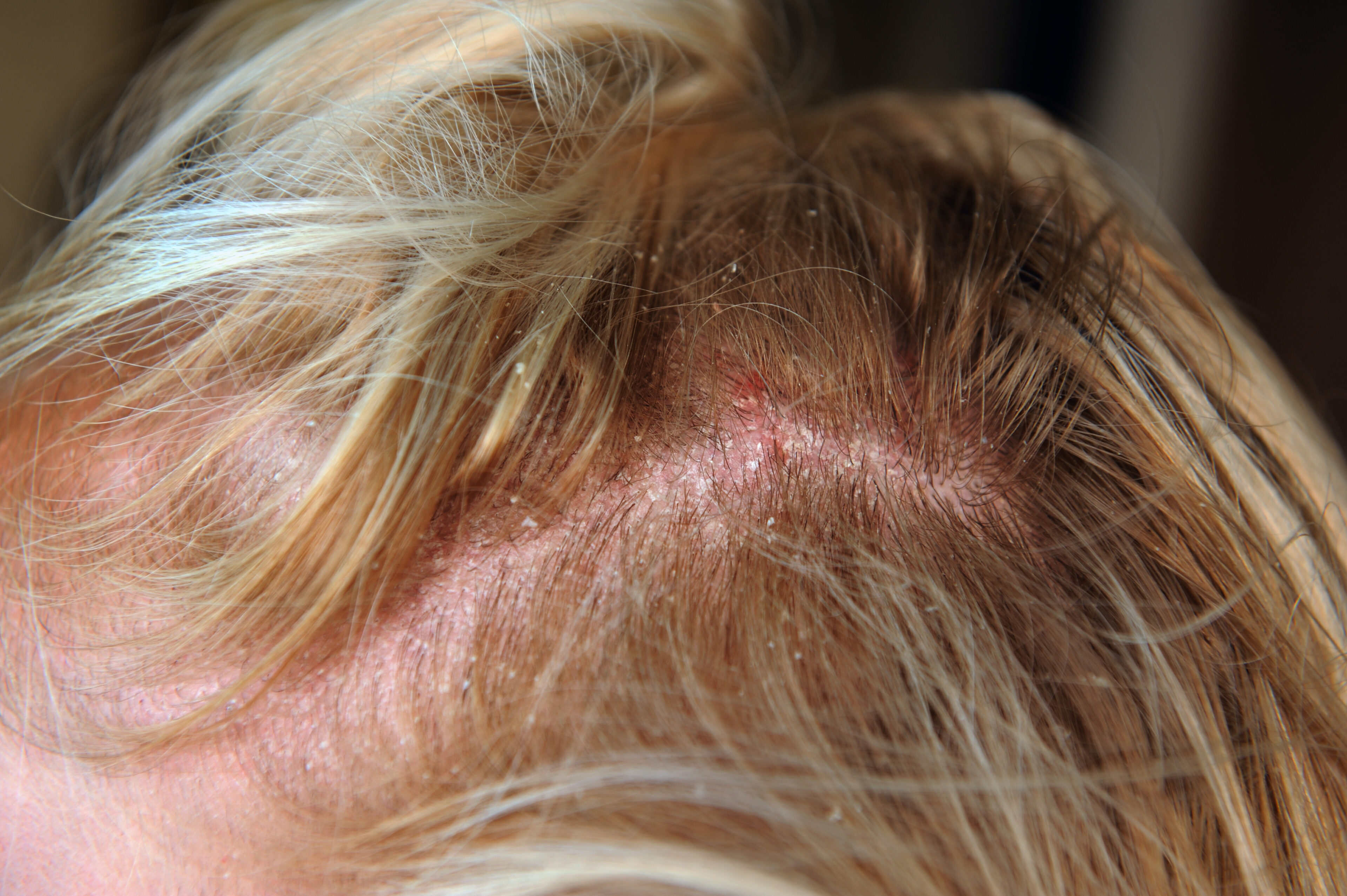 Scalp irritation
