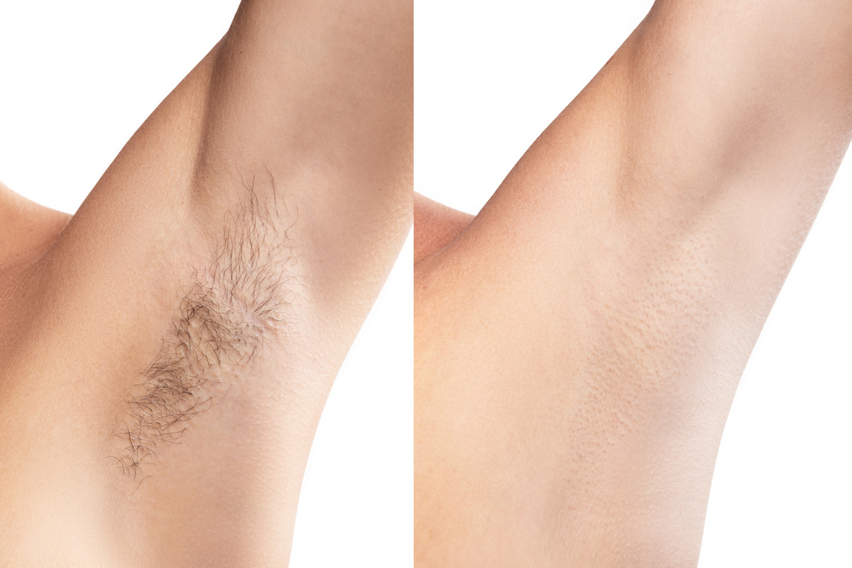 Comparison of female armpit after hair removal treatment