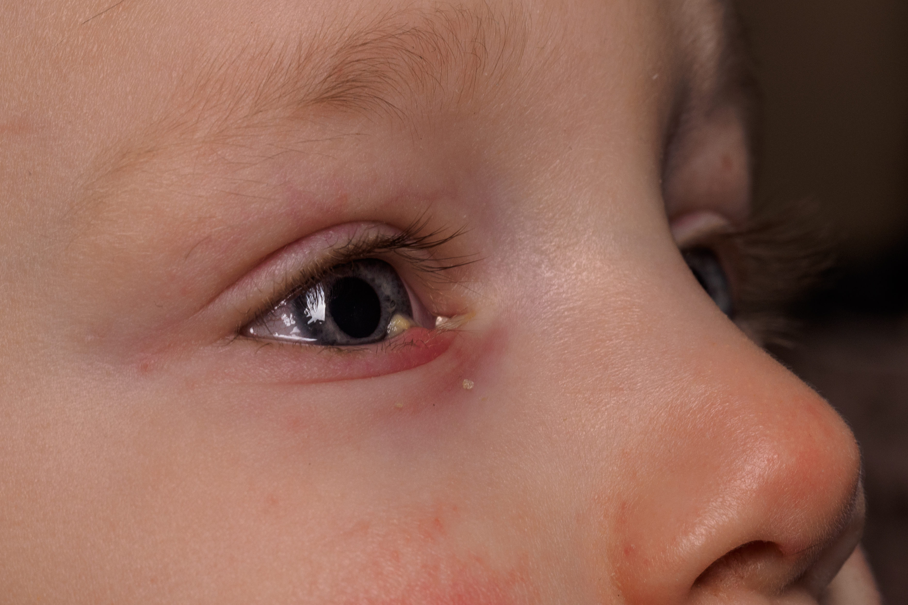 Excessive tearing eye
