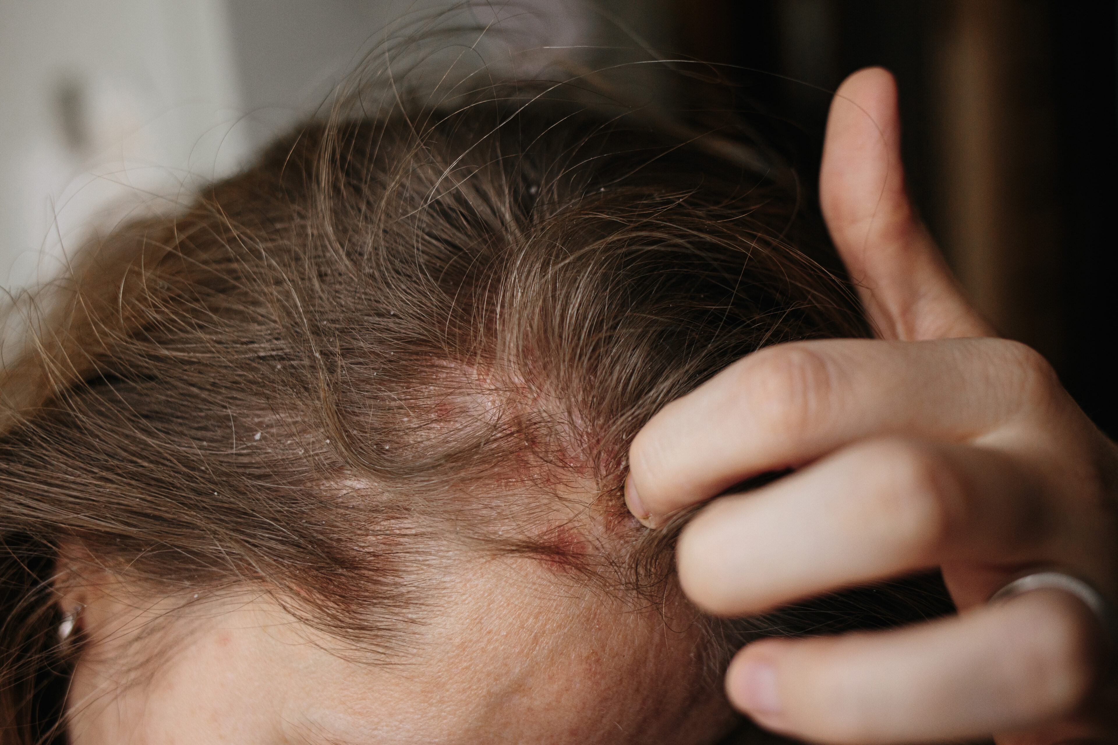 Scalp irritation