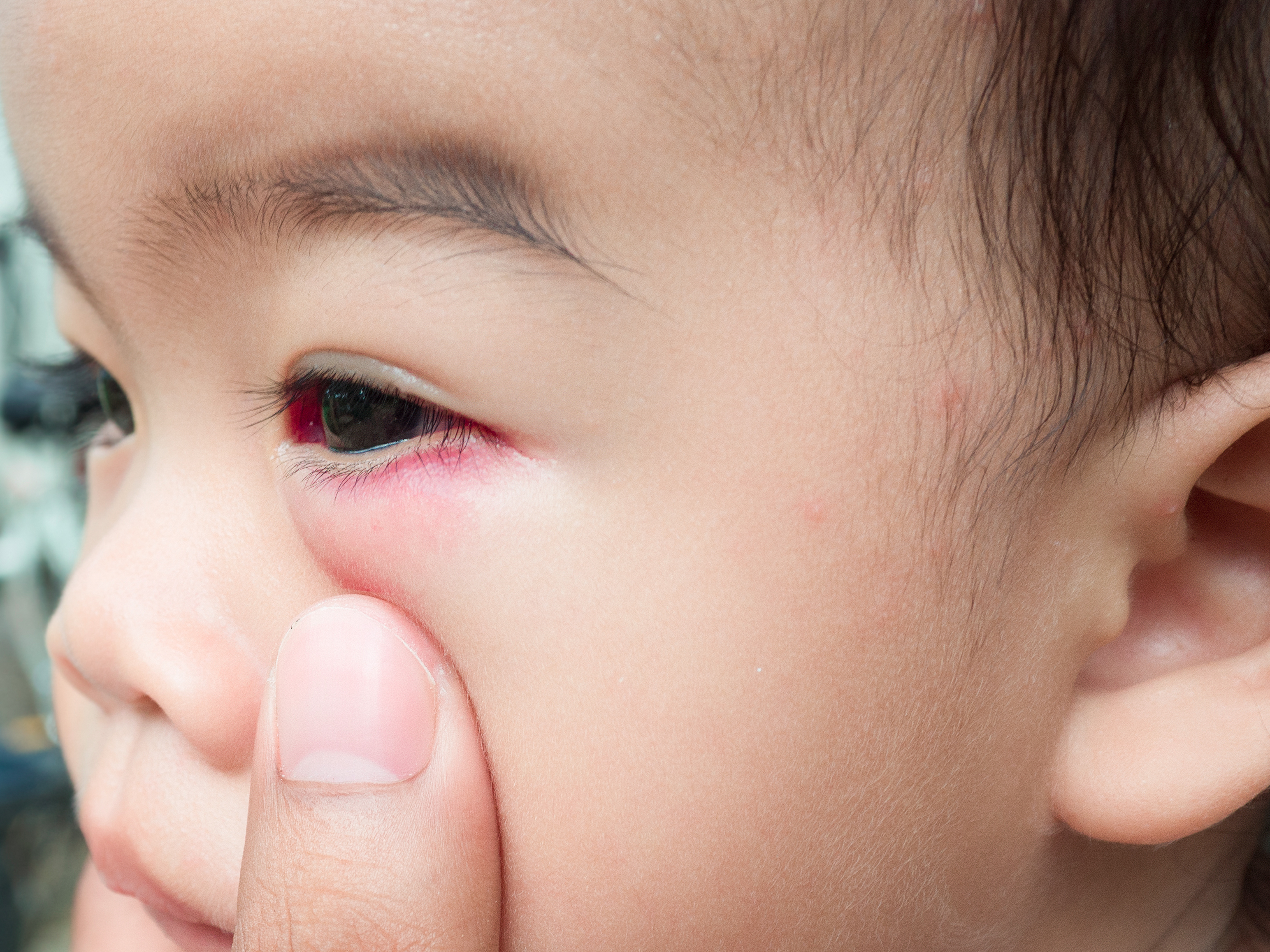 Swelling eye