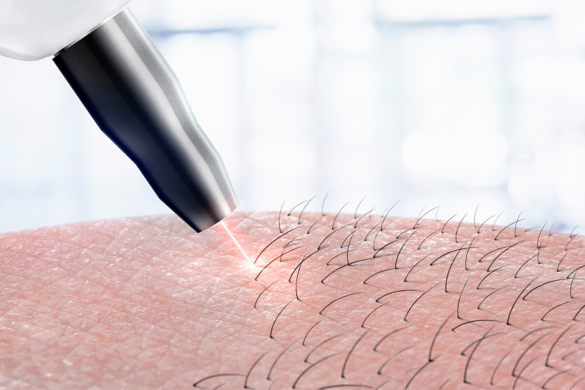 Laser hair removal armpit