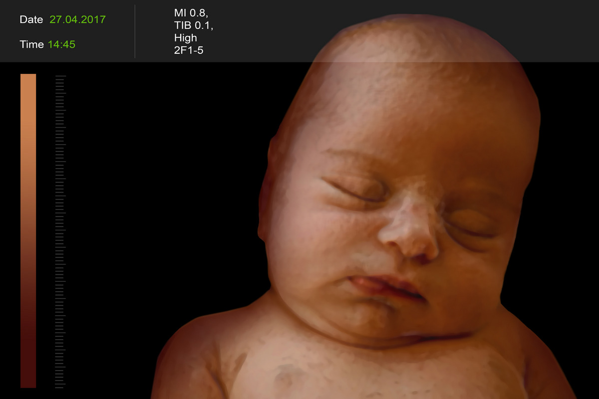 The 3D ultrasound images of the 25-week-old baby
