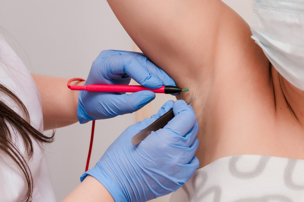 The electrolysis procedure is performed with hygienic gloves