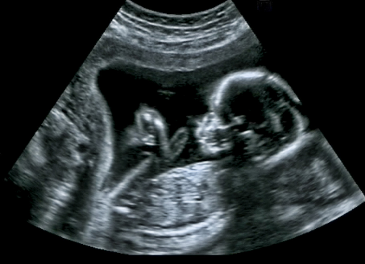 The ultrasound images of the baby in the mother's womb