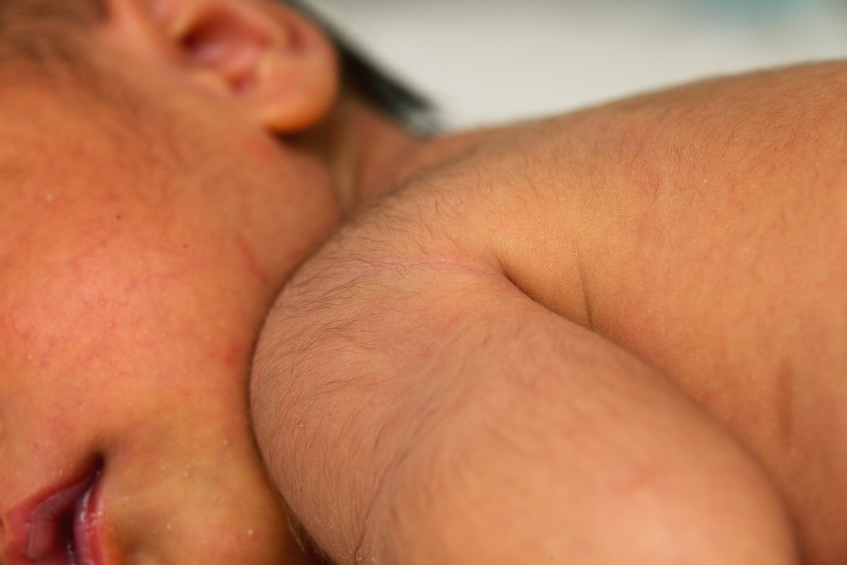 This is lanugo hair on the newborn