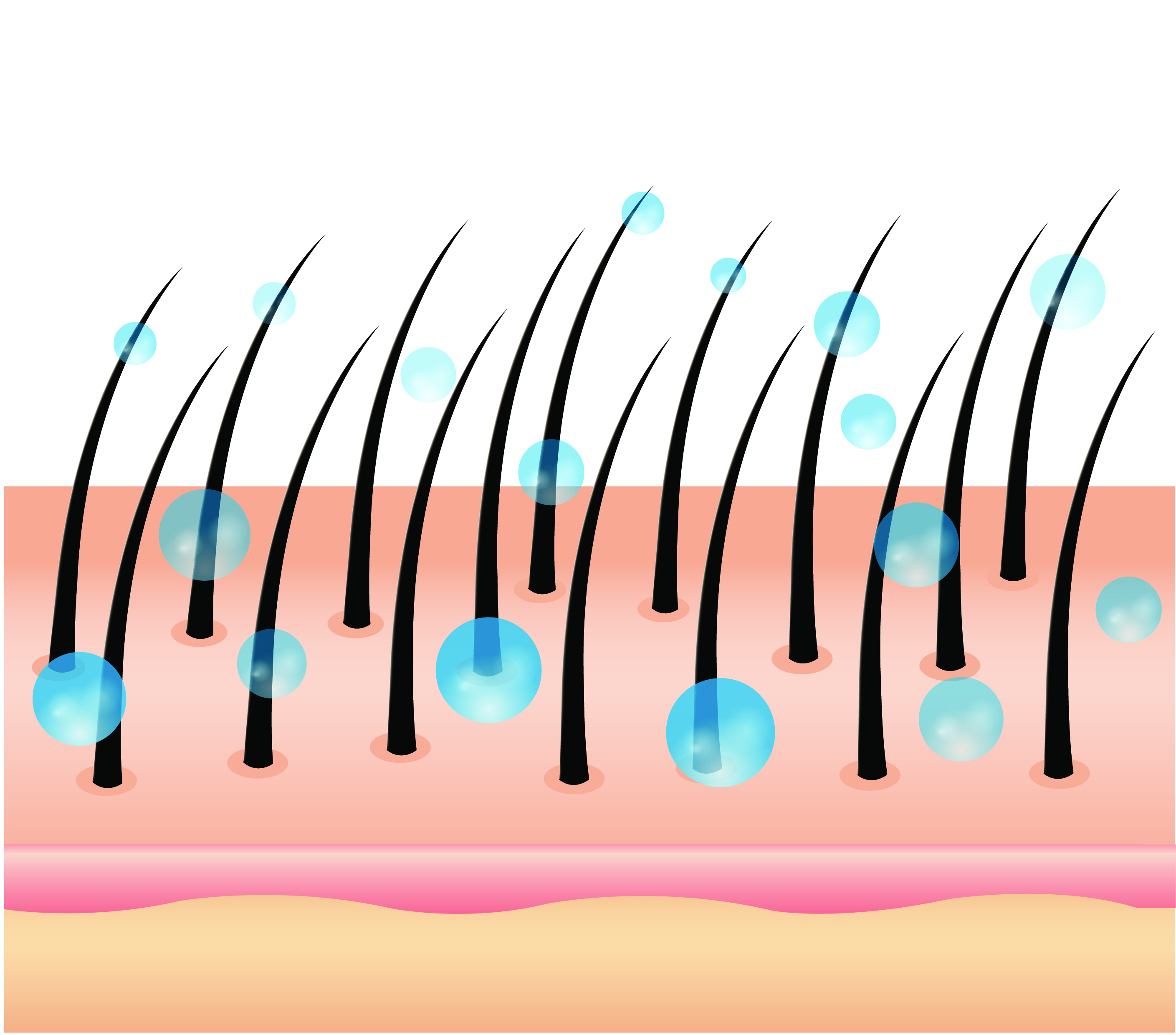 Vector illustration of scalp condition
