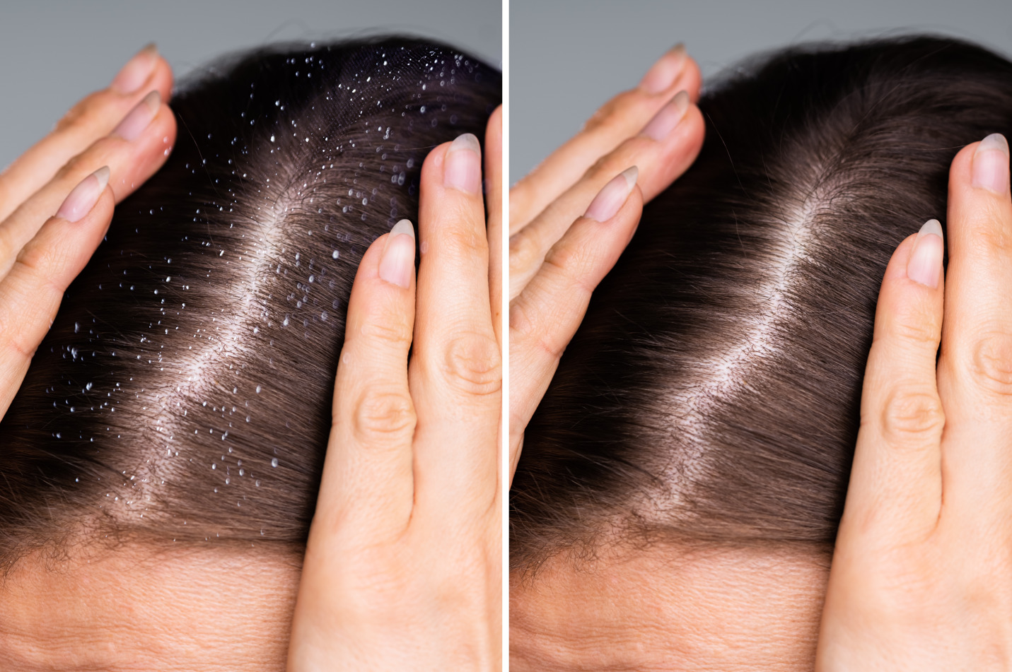 Dawn Dish Soap For Hair Growth Hood MWR