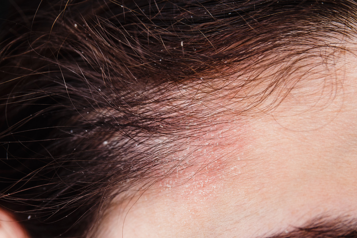 Dry scalp