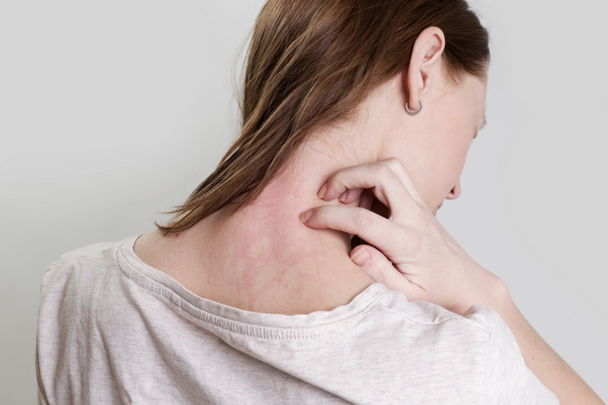 Flaky patches on other areas