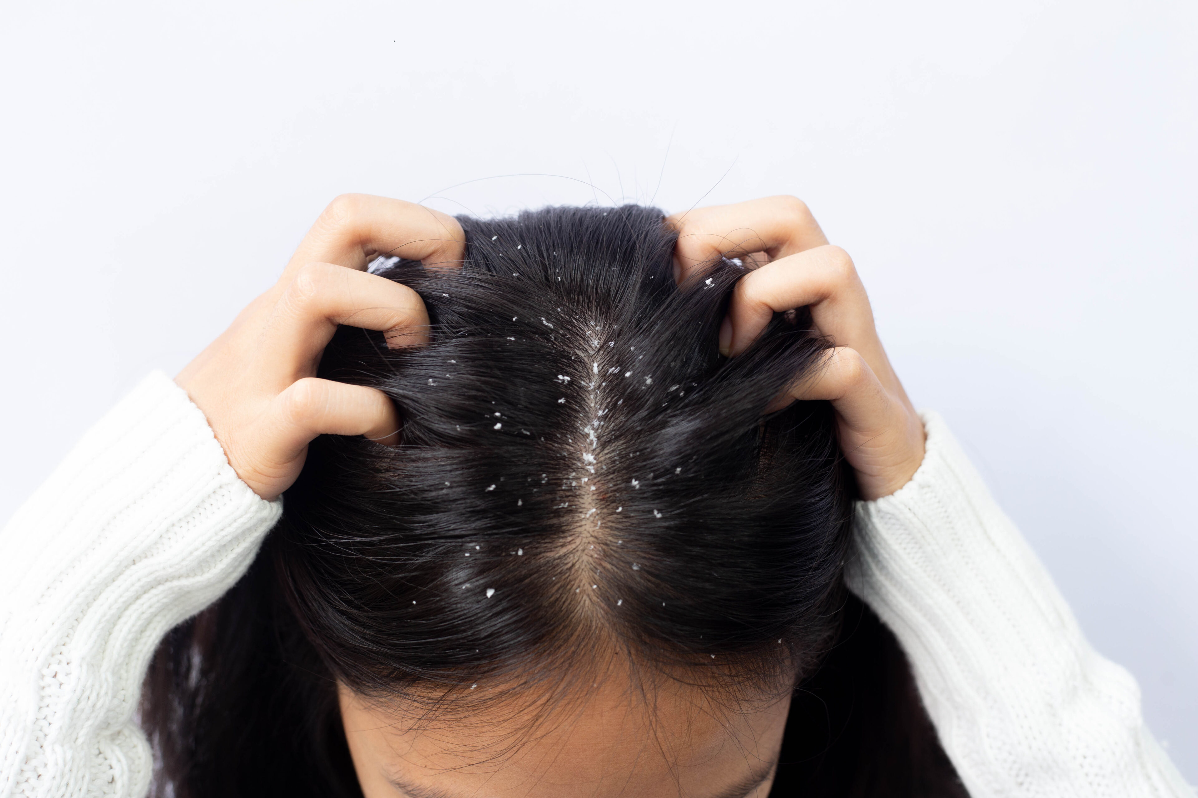How to treat and heal scabs on scalp from bleach