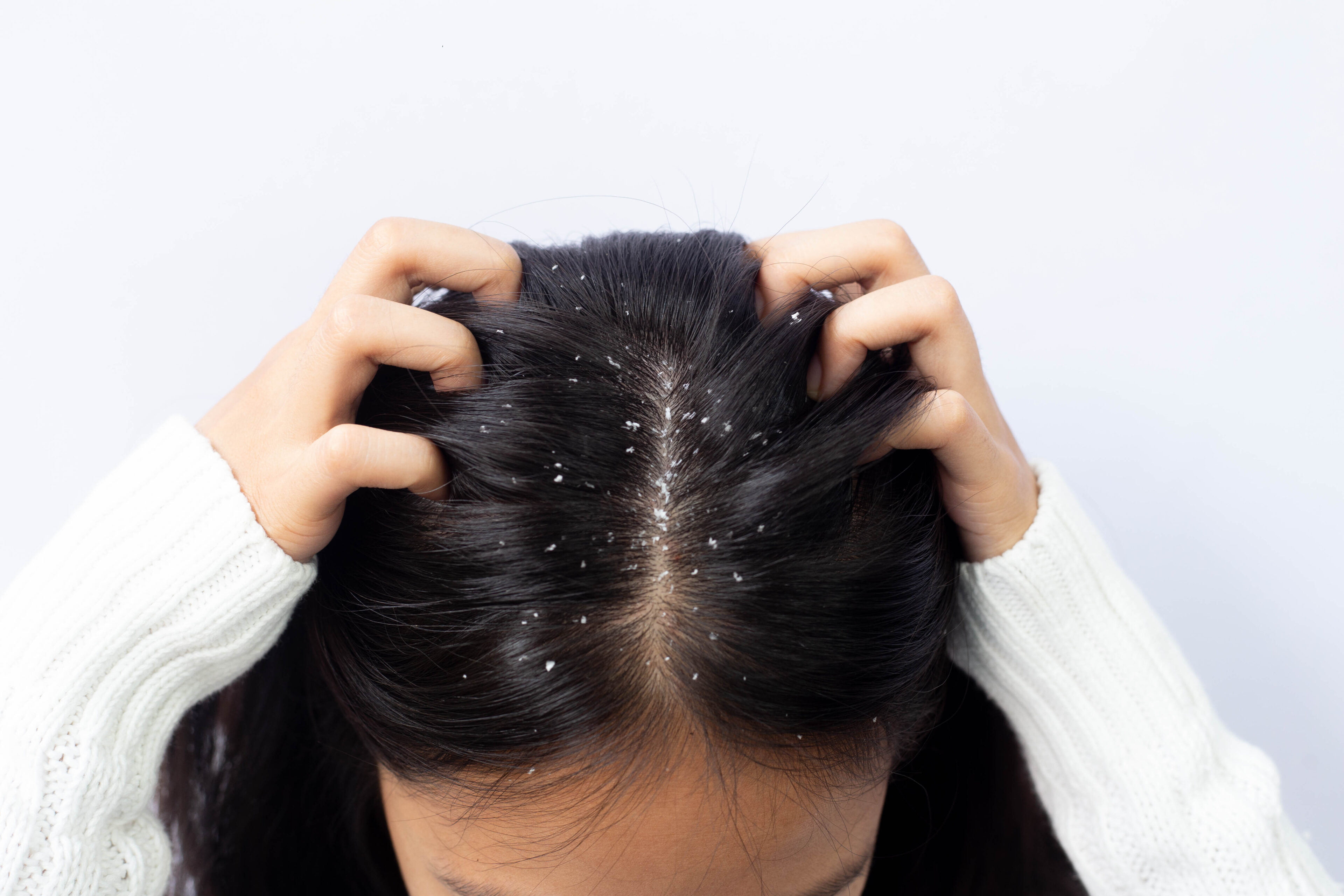 Лечение перхоти у женщин. Dandruff. Clump of Dandruff.