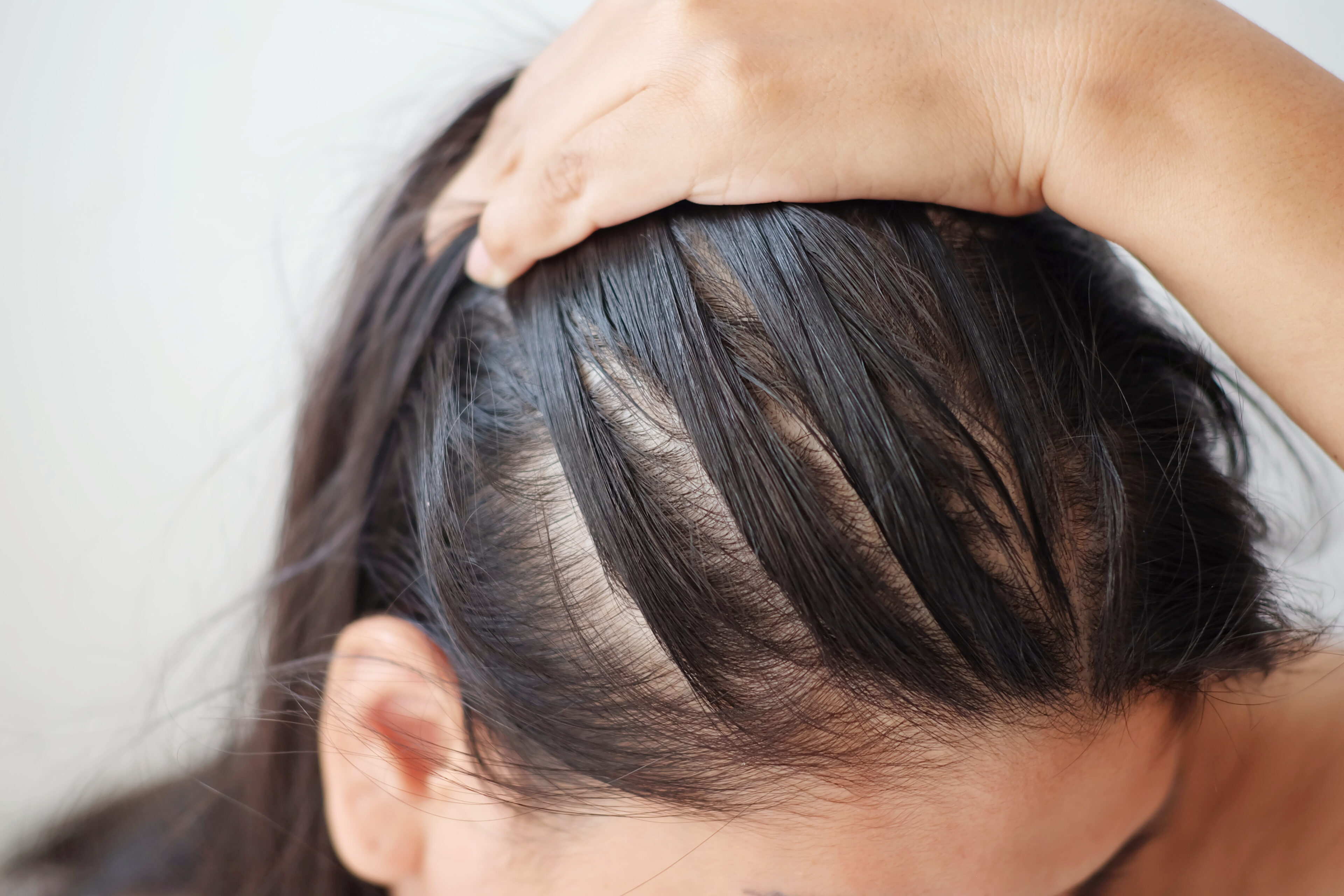 A woman with hair loss