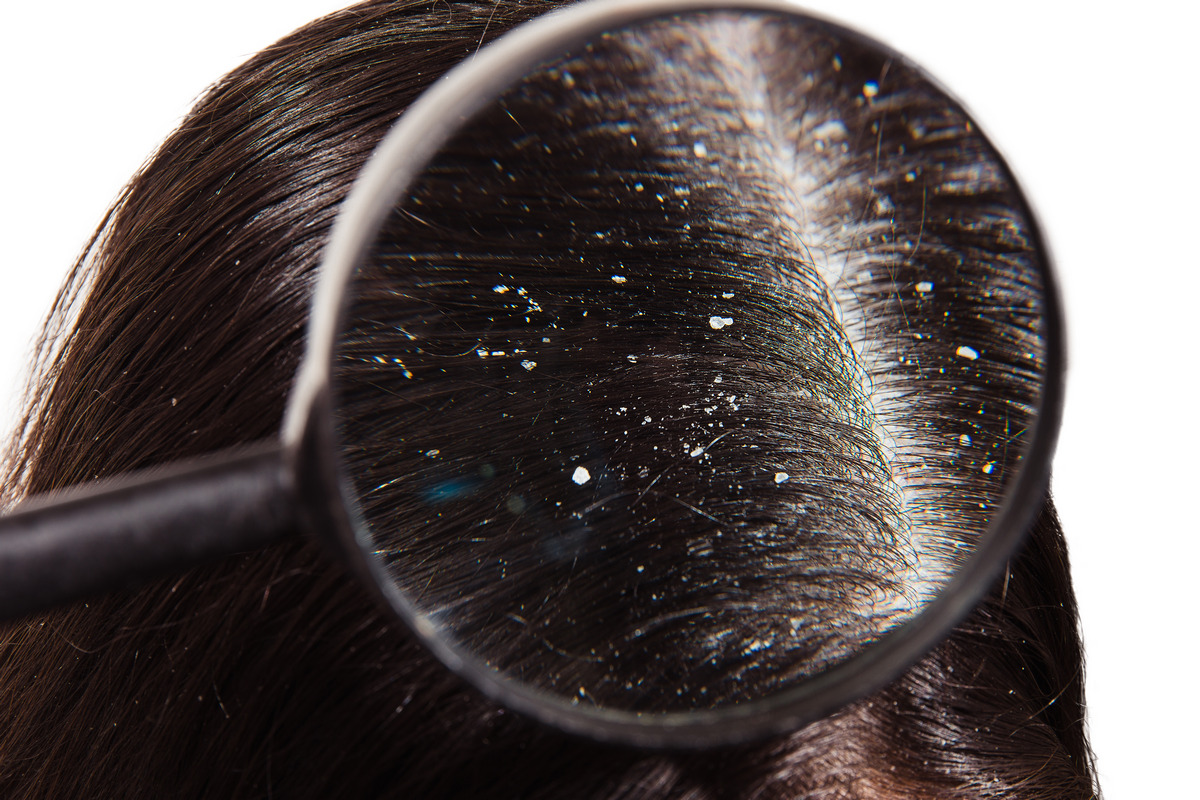 Problem dandruff in hair