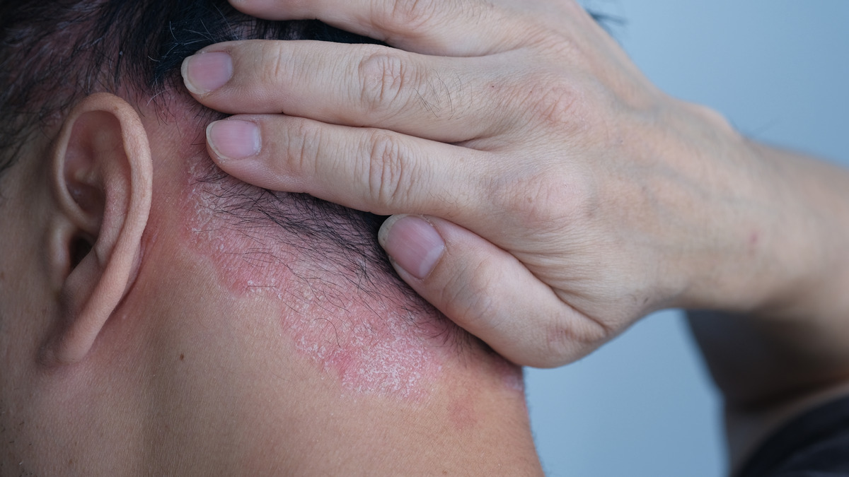 Seborrheic dermatitis