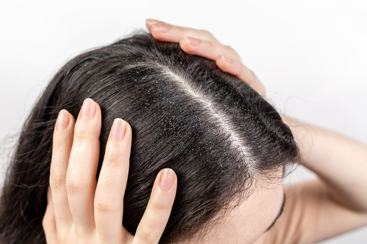 Severe dandruff