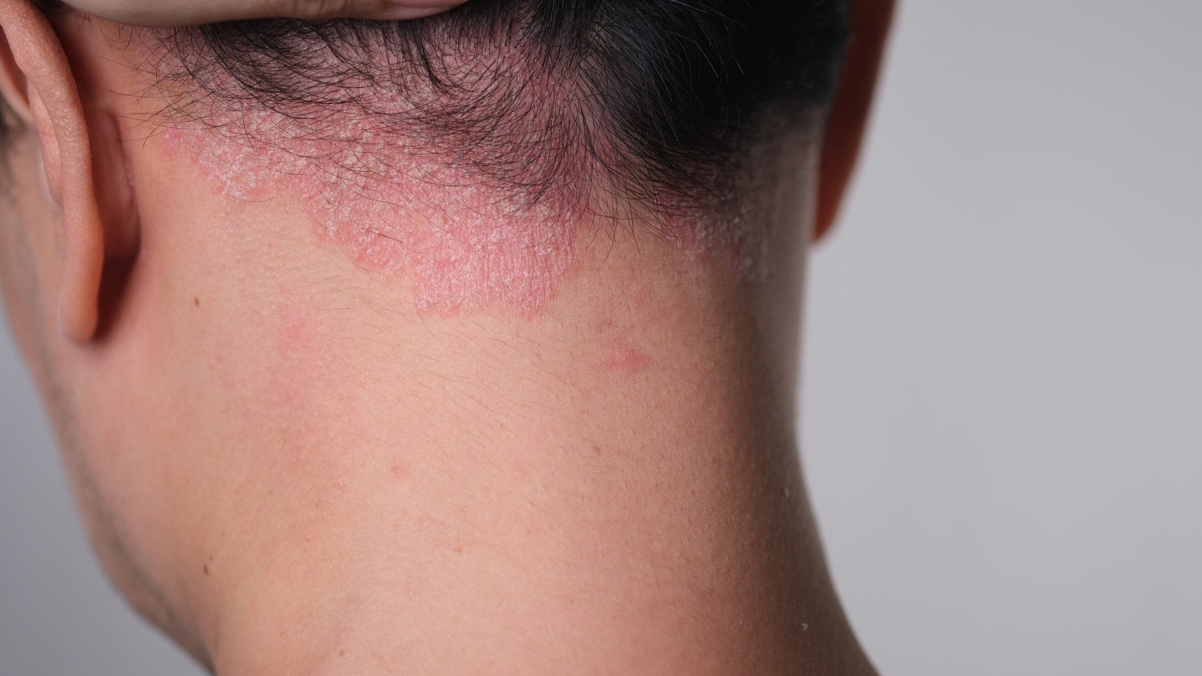 Woman has scalp irritation